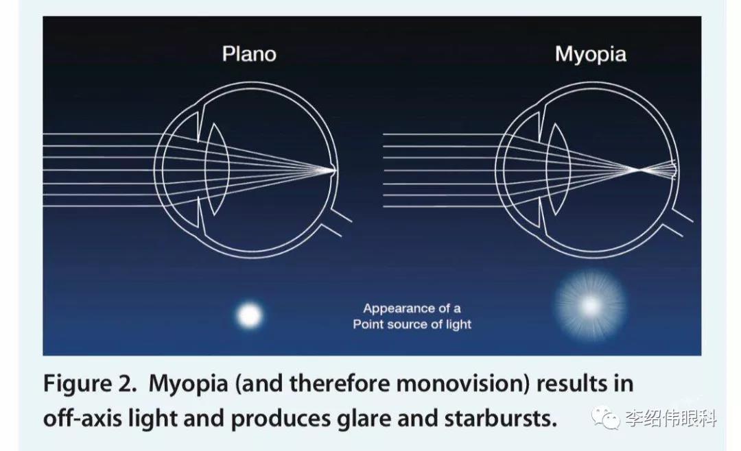 但是眩光和星芒主要来自后囊混浊,散光等屈光不正,相差,泪膜或眼表